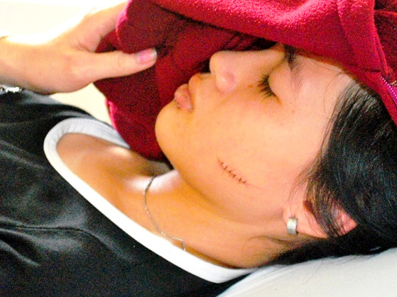 Nữ sinh với vết rạch dài trên mặt