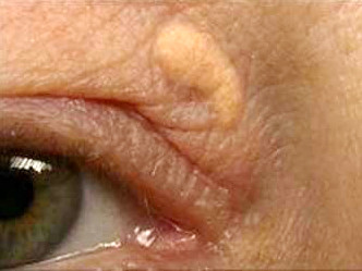 Nhìn mí mắt đoán nguy cơ đau tim