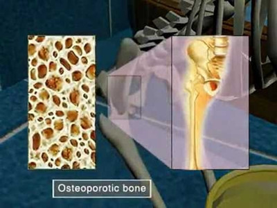 Magiê rất quan trọng đối với sức khỏe xương