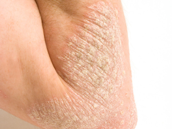 Bệnh vẩy nến cần dầu gội dành riêng