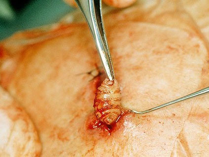 Phát hiện giòi ăn thịt sống dưới da người