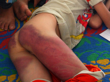 Từ công an phường về, cháu bé 11 tuổi nhập viện