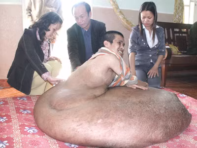 Anh Hải mang khối u dị dạng khổng lồ