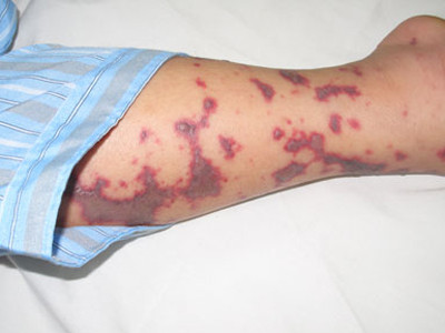 Não mô cầu lan ra miền Bắc