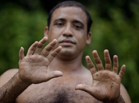 Chàng trai sở hữu 24 ngón chân tay hoàn hảo