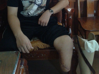 Nam sinh lớp 12 cưa chân trái vì gặp 'bác sĩ chui'