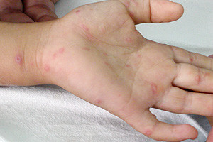 Hơn 87 nghìn người mắc bệnh chân tay miệng