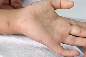 Hơn 87 nghìn người mắc bệnh chân tay miệng