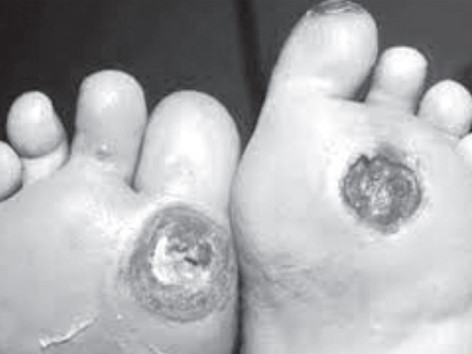 Biến chứng có thể dẫn tới tàn phế ở bệnh nhân tiểu đường