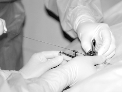 không cần phẫu thuật cắt bỏ