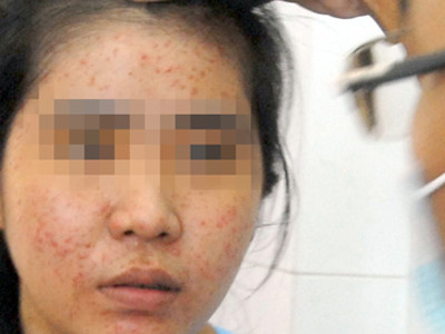 Tẩy trắng siêu tốc thành... siêu hại