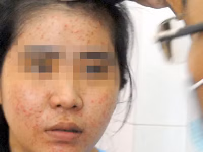 Tẩy trắng siêu tốc thành... siêu hại