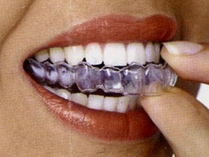 Lắp bộ răng mới nhờ máy in xương công nghệ 3D