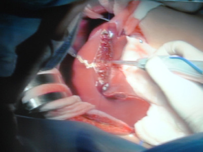 Thực hiện ca ghép gan người lớn đầu tiên