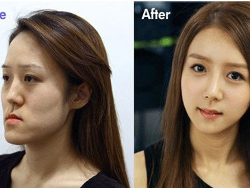 Cô gái Hàn xấu xí bỗng xinh như thiên thần nhờ... phẫu thuật