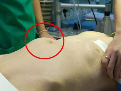 Cách mới trị phình động mạch bụng