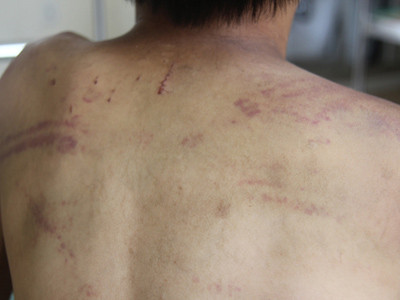 Bé trai bị bố đánh bầm dập hoảng loạn tinh thần