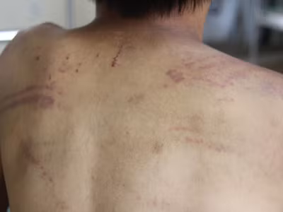 Bé trai bị bố đánh bầm dập hoảng loạn tinh thần
