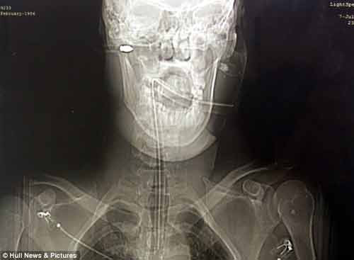 Thoát chết kỳ diệu sau khi bị mũi tên bắn xuyên đầu