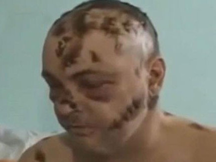 Ma túy 'ăn thịt người' bắt đầu nuốt thanh niên Mỹ