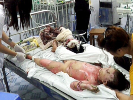 Cháu Trần Thị Huyền (4 tuổi) khi đang điều trị tại Bệnh viện Việt Tiệp (Hải Phòng). Ảnh: Lam Khê