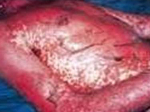 Làm gì khi bị dị ứng với thuốc trị gout?