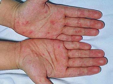 Virus gây tay chân miệng chưa biến đổi độc lực