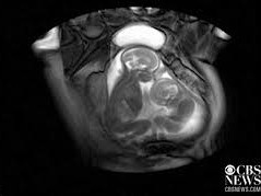 Video trẻ sinh đôi đá nhau giành chỗ trong bụng mẹ