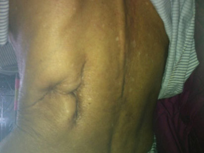 Tự tay cầm dao rạch lưng, lấy sỏi thận