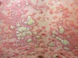 Tìm lại niềm vui sau nhiều năm bị vẩy nến