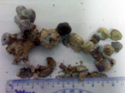 Đông y chữa sỏi thận