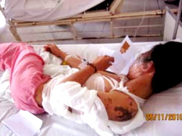 Học sinh lớp 10 bị tạt axít ngay tại nhà