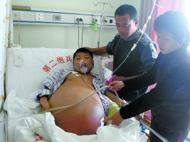 Chàng trai 20 tuổi bế 'bụng bầu' 13 năm