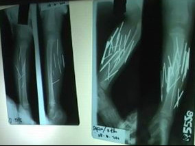 Bé gái mọc 27 chiếc đinh trong chân