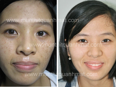 Nhiều bạn trẻ đau khổ vì mụn thịt