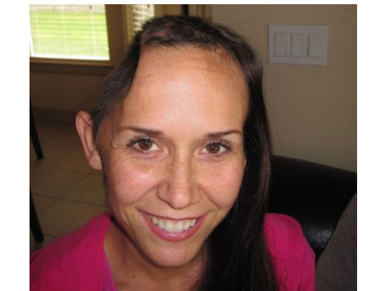 Cô Jamie Hilton và bức ảnh chụp cô bị khuyết một phần sọ