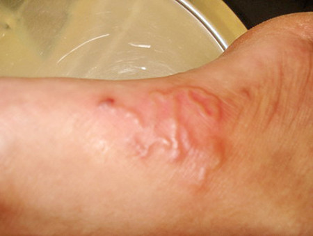 Kinh hoàng bệnh nhân ‘giun bò lổn nhổn dưới da’