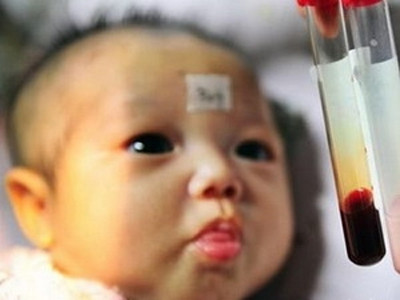 Phát hiện nguy cơ Down ở trẻ qua xét nghiệm máu