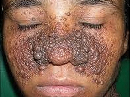 Những hình ảnh đáng sợ của ung thư da