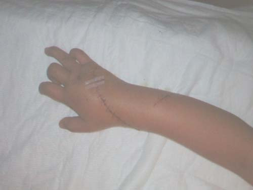 Bàn tay cháu Bích đang phục hồi tốt