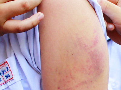 Học sinh lớp hai bị cô giáo đánh bầm tay bằng thước