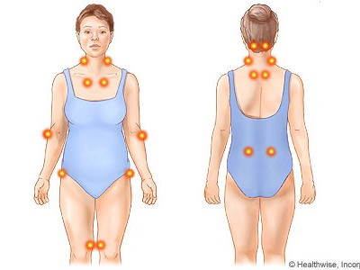 Sống chung với bệnh đau xơ cơ