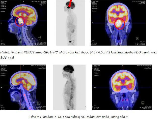 Chữa khỏi ung thư ở Việt Nam sau khi điều trị tại Singapore