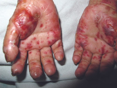 Phát hiện bệnh 'ma cà rồng' tại Việt Nam