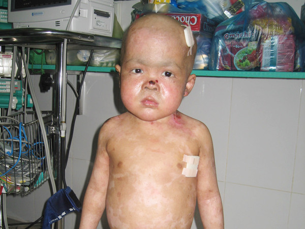 Lần đầu ghép tủy ca bệnh hiếm gặp