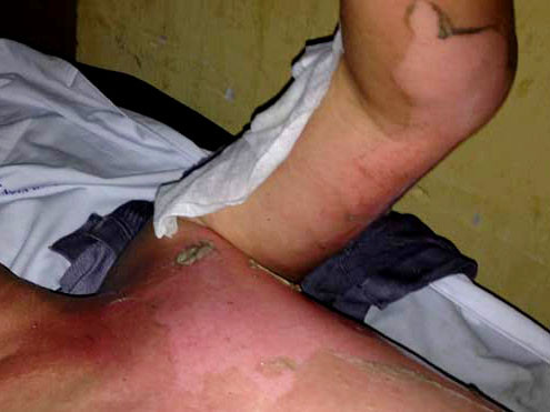 Hắt nước sôi vào mặt bạn tù