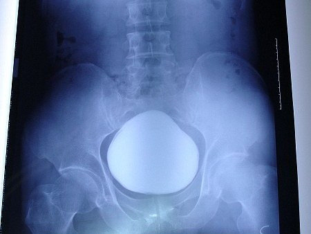 Mổ lấy sỏi nặng hơn 1 kg khỏi bàng quang