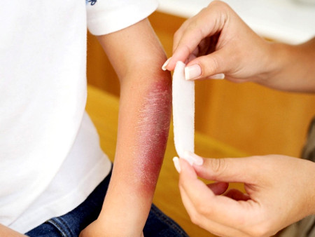 Những lưu ý khi chăm trẻ bị bỏng