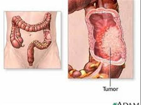 Vì sao bị viêm loét đại trực tràng chảy máu?