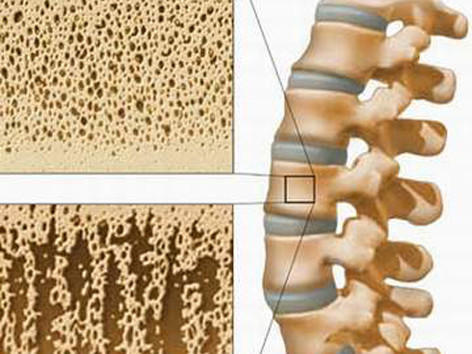 Loãng xương "kẻ ăn cắp” giấu mặt
